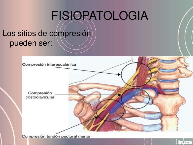 Sindrome De Paget Schroetter Pdf Download